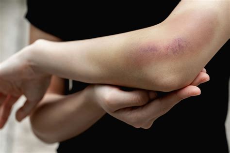 best concealer for bruises Cheaper Than Retail Price> Buy Clothing, Accessories and lifestyle ...