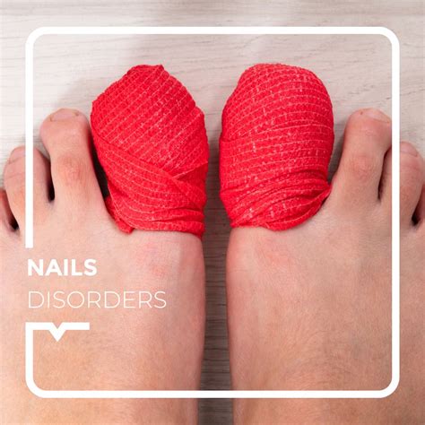 Whitlow, ingrown nails and other nail problems - Alegria Medical Centre