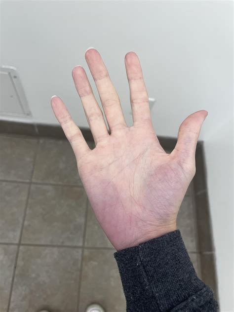 Hand discoloration when cold. Any ideas? : r/medical