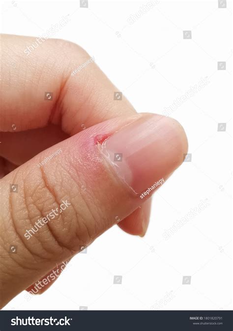 Ingrown fingernail : 580 images, photos et images vectorielles de stock | Shutterstock