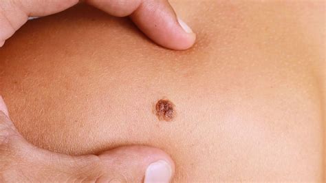 Las diferencias entre un lunar sano y uno cancerígeno: las claves para ...