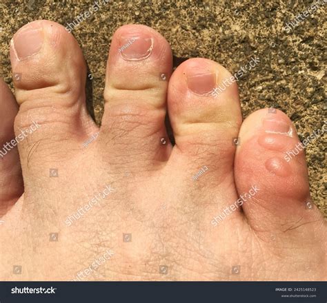 23 Blister Pinky Toe Royalty-Free Images, Stock Photos & Pictures | Shutterstock