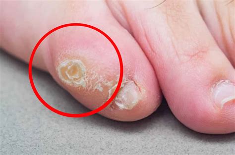 Surgery Corn Removal - Corn Removal Surgery