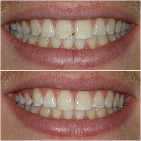 how to fix a chipped tooth - Dental Specialist Clinic