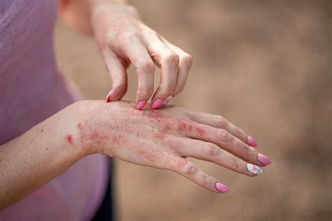 Contact Dermatitis: Types, Symptoms, Causes, Diagnosis, Treatment, and More