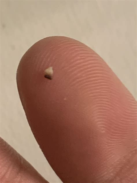 Can a skin bridge happen in the middle of a penis? I noticed a skin bridge looking thing a while ...