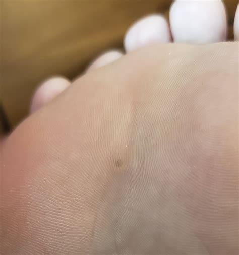 Painful spot on my foot, covered with hardened but transparent skin ...