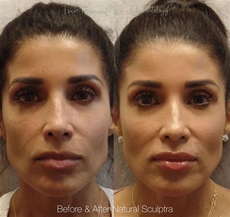 Facial Volume with Sculptra - Houston, TX Dermatologist
