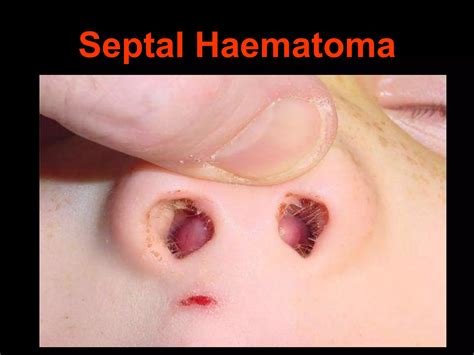 Nasal Septal Haematoma