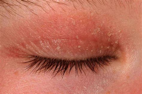 Eyelid Dermatitis: Understanding Types, Triggers, and Hereditary ...