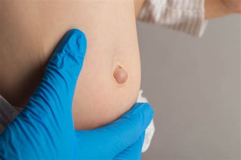 Hernia Causes Inguinal Hernia Groin Hernia