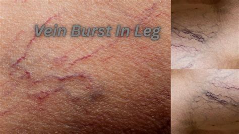 Vein burst in leg - Elite Vascular | New Jersey's Trusted Vascular ...