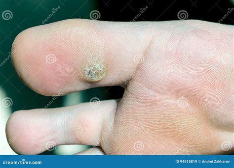 Toe Finger Warts at Bill Eley blog