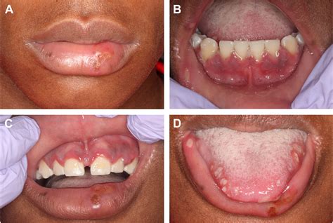 Herpesvirus-Related Lesions of the Oral Mucosa - Oral and Maxillofacial ...