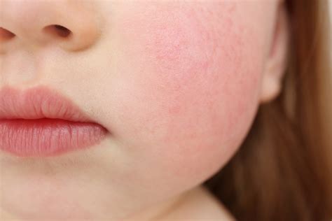 Red Cheeks Teething Or Fifth Disease at Tashia Wood blog