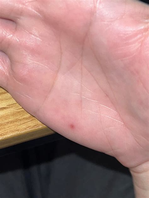 Small red bump on palm of hand : r/skin