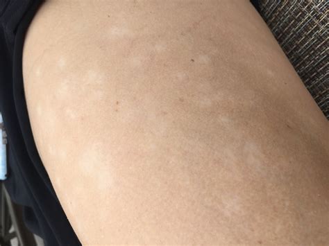 White Bumps On Arms