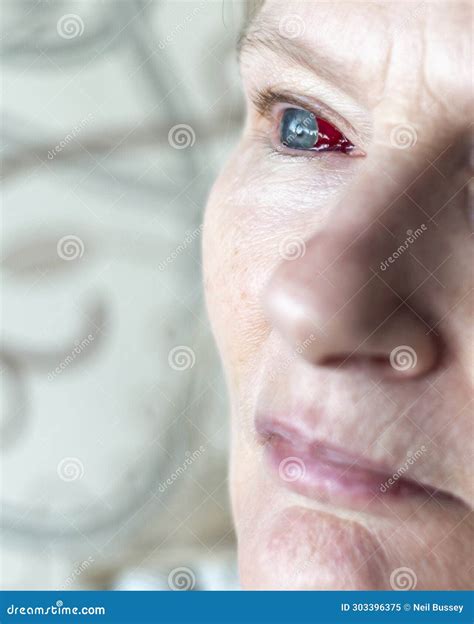 Subconjunctival Hemorrhage in the Right Eye of a Middle Aged Woman, at Her Home,Worcestershire ...