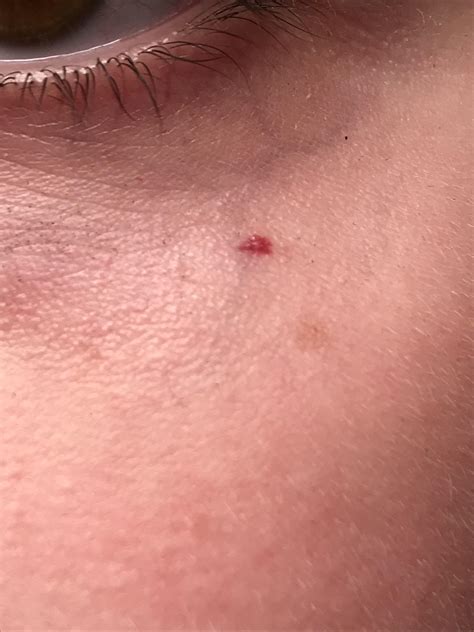 Red dot under my eye appeared over night. What is it? : r/SkincareAddicts