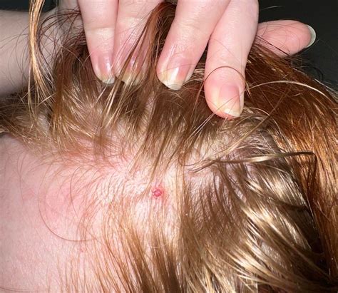 What is this lump on my head? : r/DermatologyQuestions