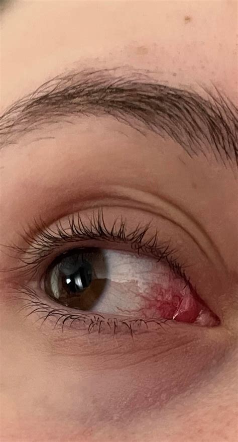 Redness and stinging in inner corner of right eye : r/Dryeyes