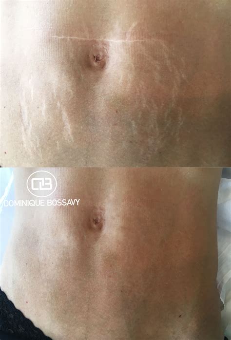 Body Makeup Cover Stretch Marks at Hunter Wang blog