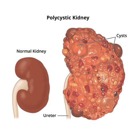 Kidney Disorders - EDUQODE