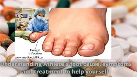 Athlete's Foot Symptoms Australia at Norman Nelson blog