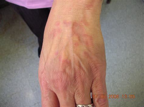 Granuloma Annulare Pictures: Granuloma Annulare Treatment – EYZA