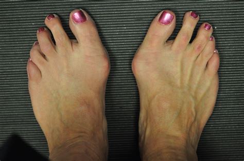 What Does A Bunion Look Like On Your Foot | Detroit Chinatown