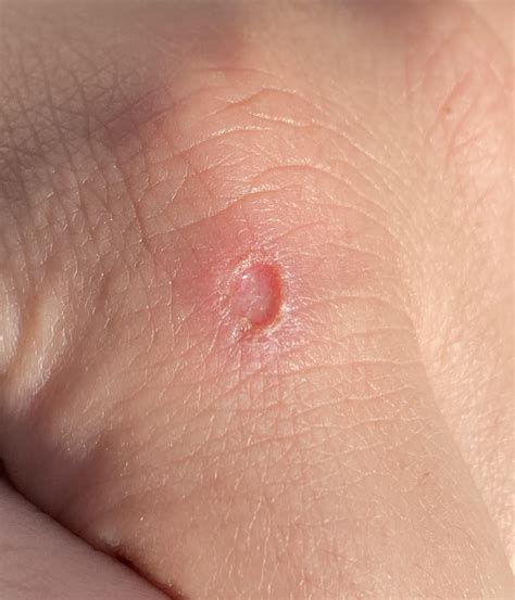 Wound on hand that won’t heal : r/woundcare
