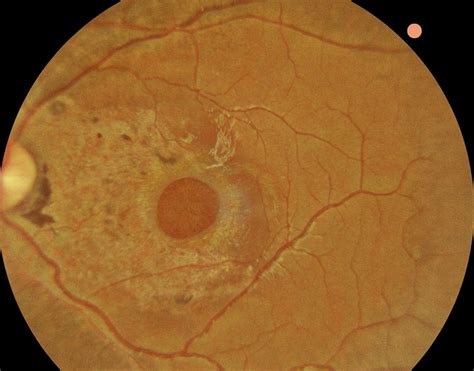 Surgical Repair of Spontaneous Full-Thickness Macular Holes Can Improve Visual Acuity ...