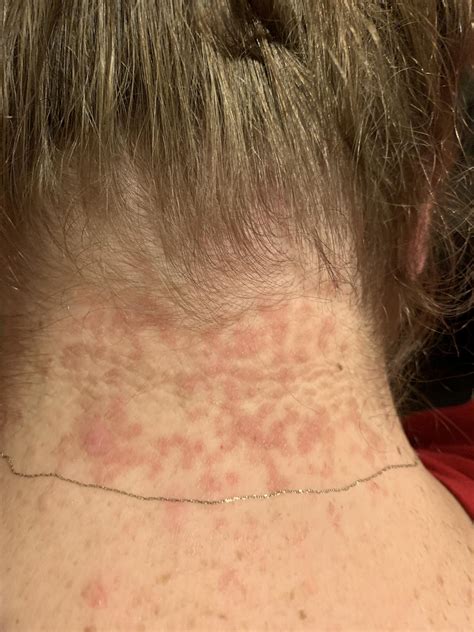 Rash On Back Of Neck Rash On Back Of Baby's Neck/hair Line