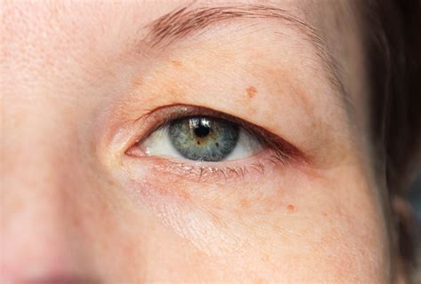 Ptosis (Droopy Eyelid) Causes & Treatment in Charlotte, NC