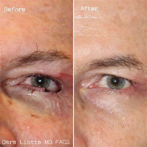 Mohs Reconstruction - New York City - Dr. Dara Liotta