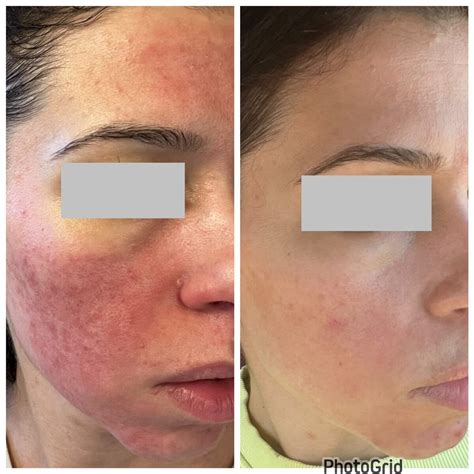 Rosacea Transformation Photos | The Rosacea Method Successes