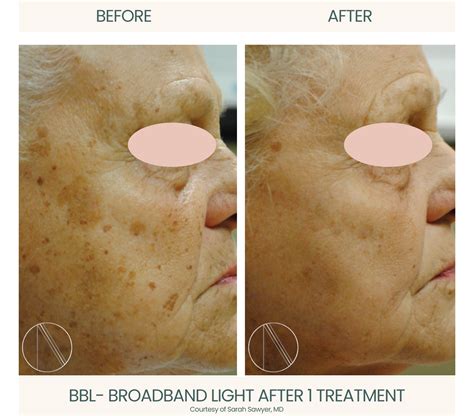 What Is BBL Face Treatment? Benefits, Process, and Safety Explained - Ayana Dermatology & Aesthetics