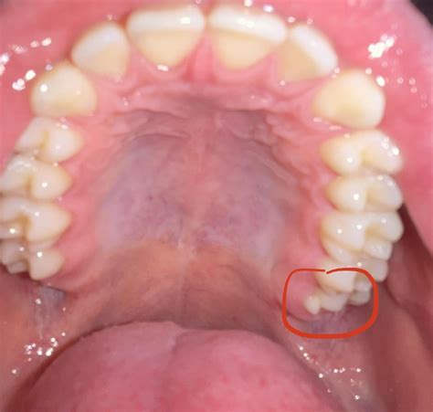 I have what looks like a sharp extra cusp lingual to my Left 3rd molar ...