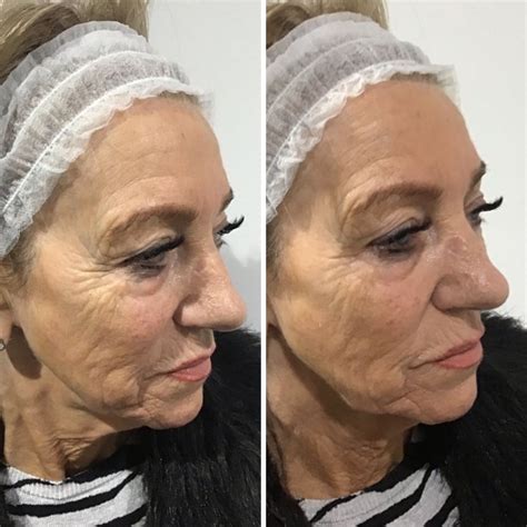 Non Surgical Face Lift Houston at Dorothy Hood blog