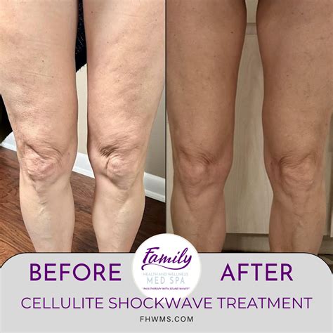 Cellulite Treatment - Family Health and Wellness Med Spa