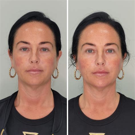 Surgical Face Lift Non Surgical Facelift Treatment