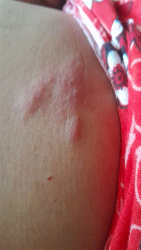 The awareness of Shingles & the use of vaccination to prevent Shingles | by GOWTHAM M | Dec ...