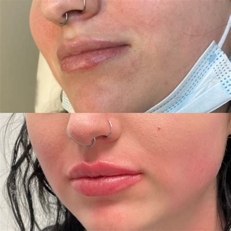 Lip Filler at Detroit Plastic Surgery & Med Spa - Detroit Plastic Surgery & Medical Spa