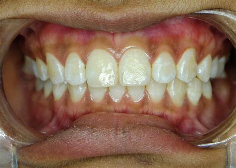 What is the Small Black Point on my Tooth?