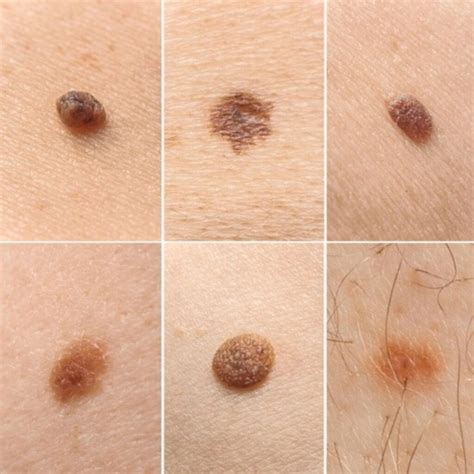 Intradermal Nevus: Understanding the Common Skin Growth