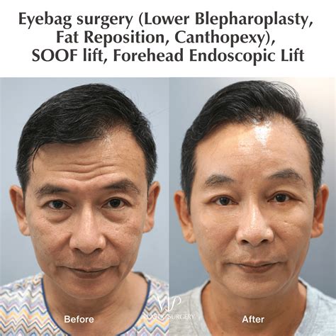 How to Get Rid of Eye Bags: Effective Surgery Options | VIP