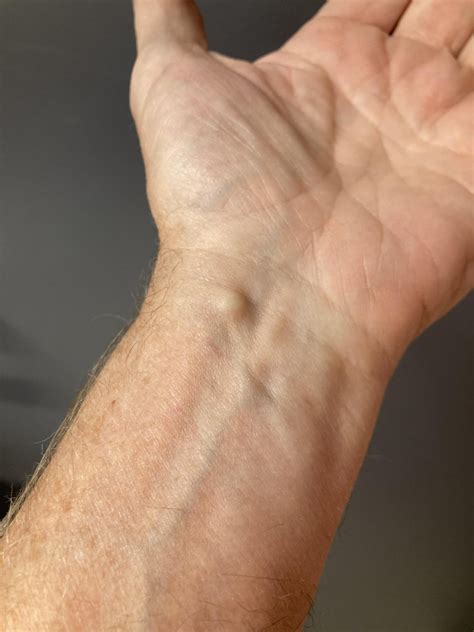 What is this bump on the inside of my wrist? : r/medical