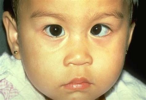 Amblyopia, lazy eye, causes, symptoms, diagnosis, treatment & prognosis