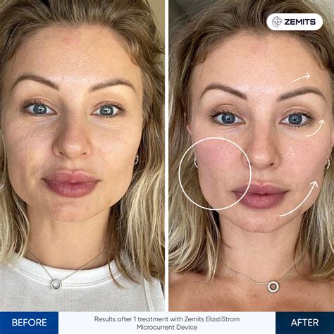 WHOLESALE Zemits Elastistrom Microcurrent Gloves