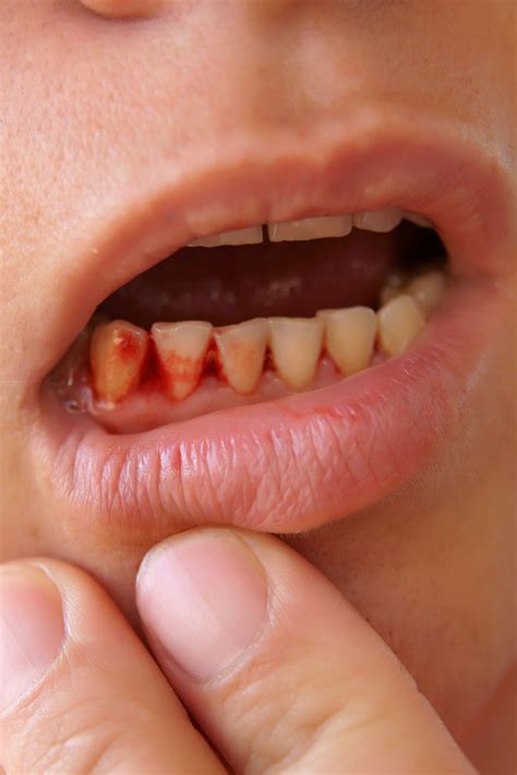 Bleeding Of Gums Caused Due To Vitamin Deficiency